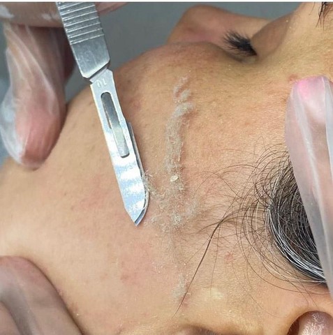 Dermaplaning facial Beleza e sa de Santa Cruz Industrial