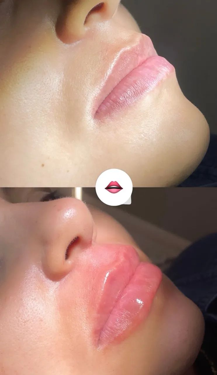 Preenchimento Labial R$450 - Foto 3