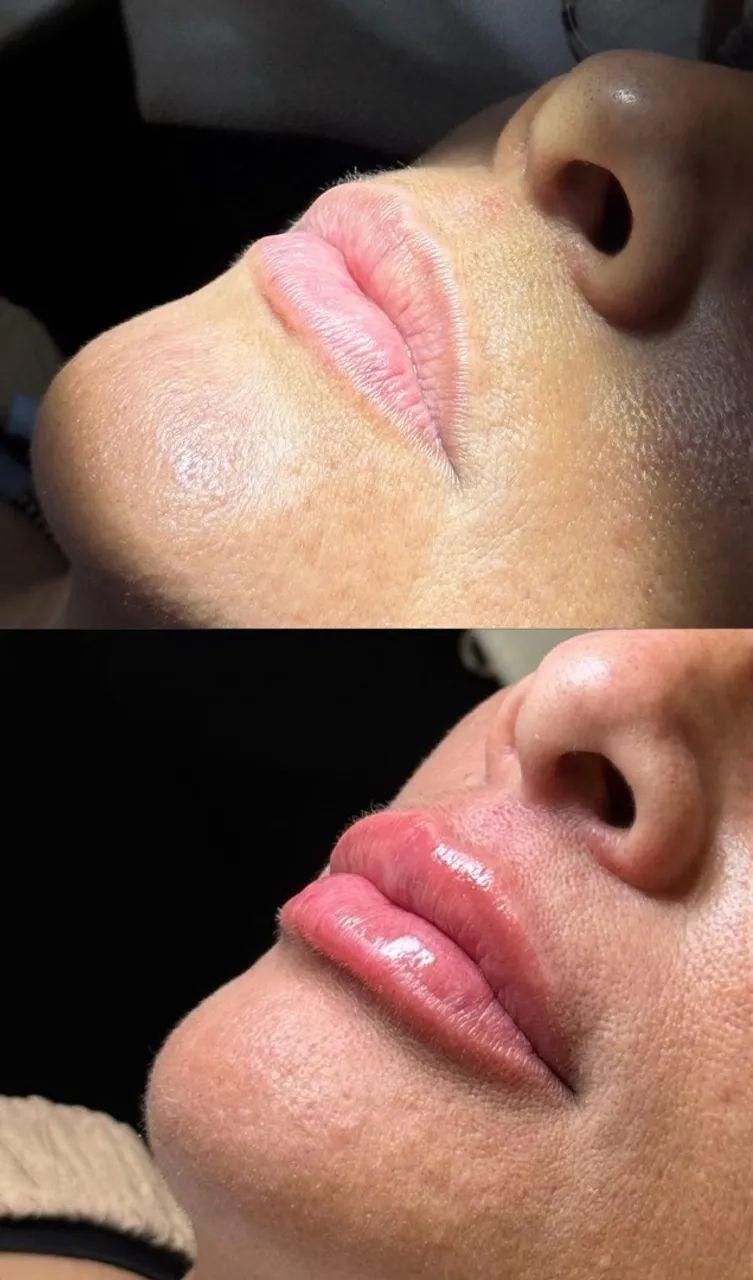 Preenchimento Labial R$450 - Foto 4