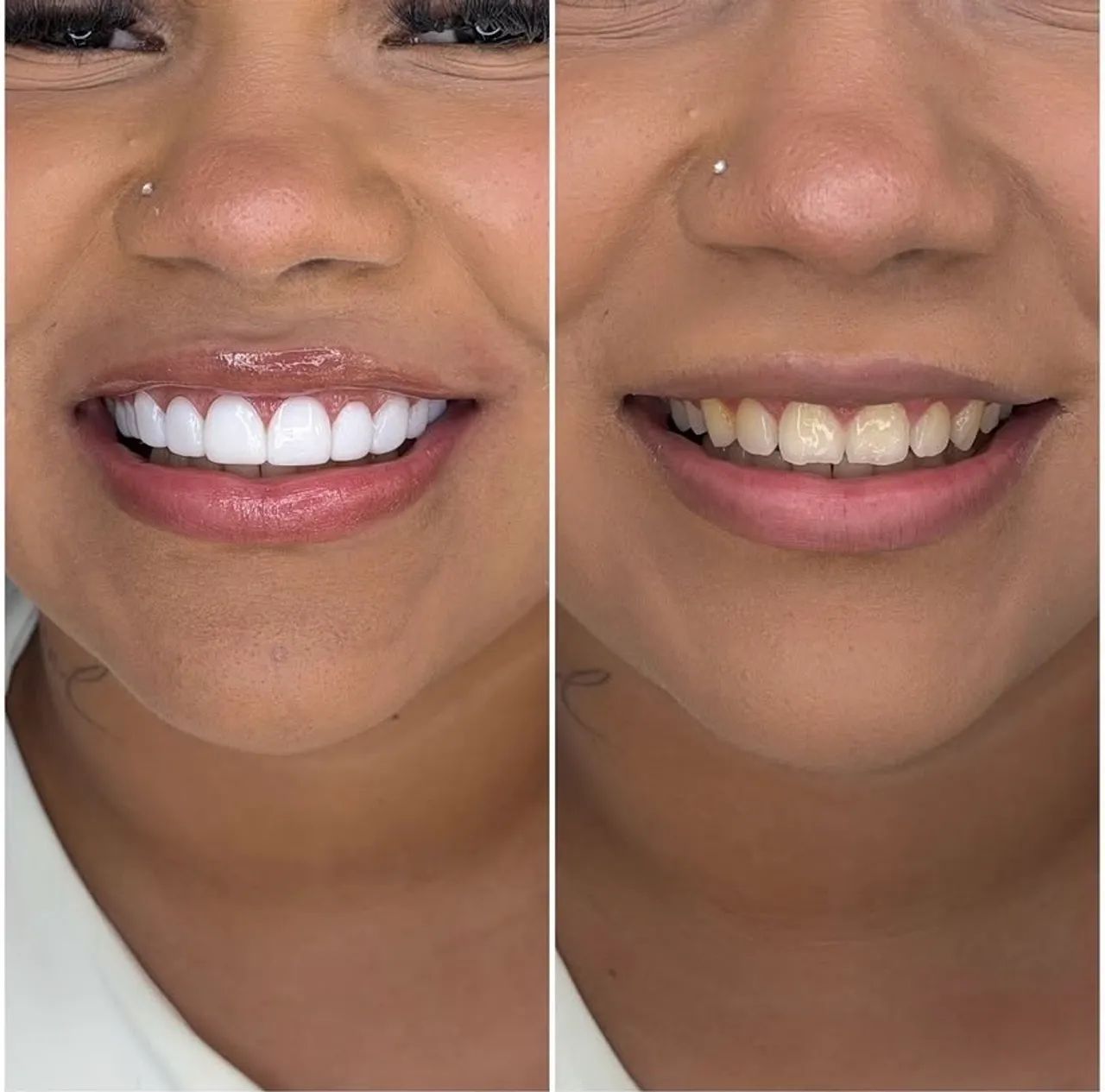 Facetas em resinas  - Foto 5