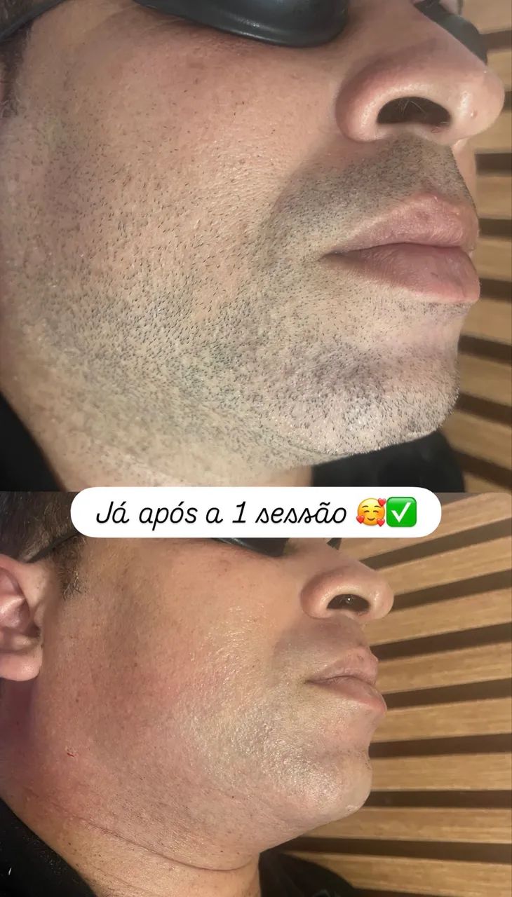 Depilação a Laser - Foto 2