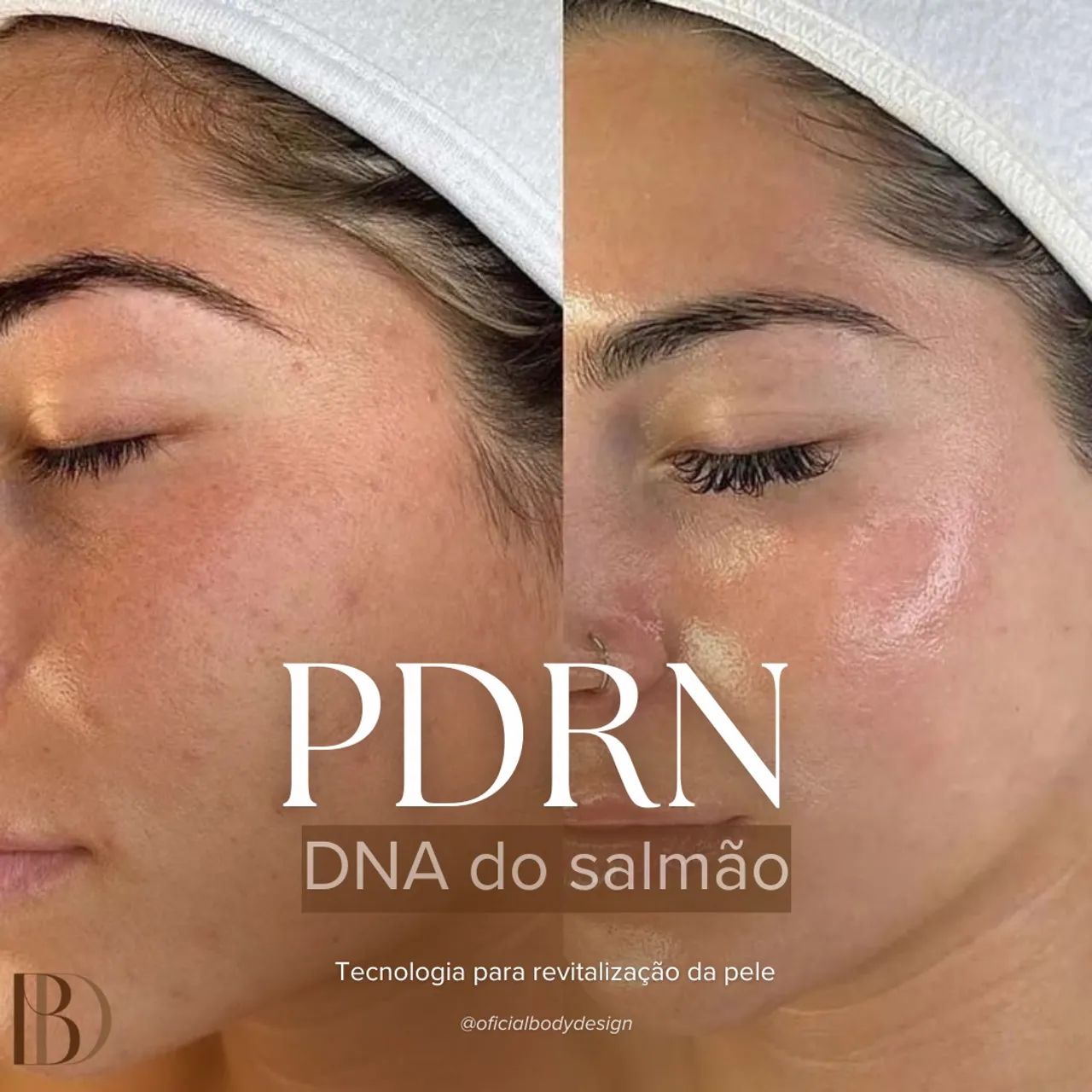Rejuvenescimento facial 