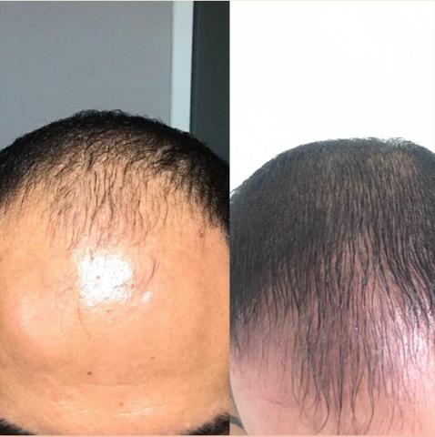 O melhor minoxidil - Foto 2