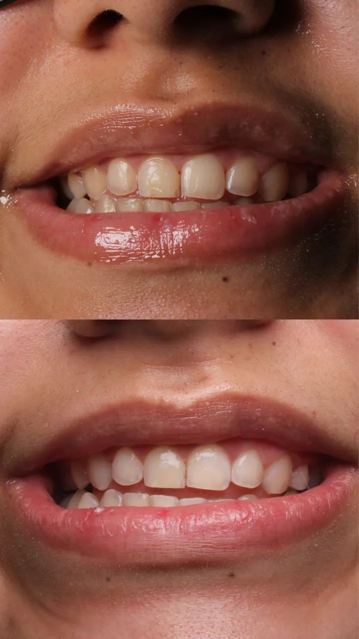 Clareamento dental em consultório  - Foto 3