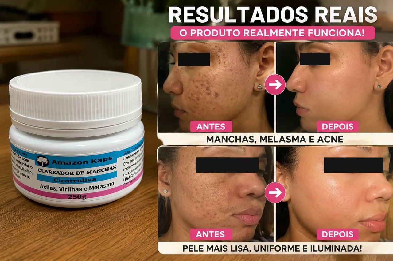 Creme para Manchas na Pele -Espinhas e Marcas - Foto 2