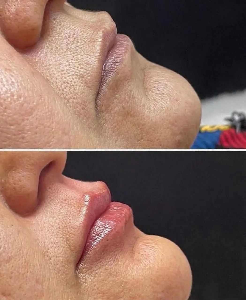 Preenchimento Labial R$450 - Foto 5