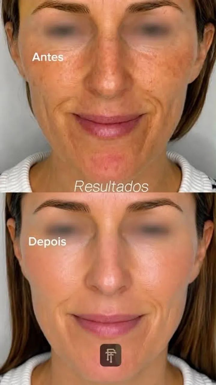 Rejuvenescimento facial  - Foto 2