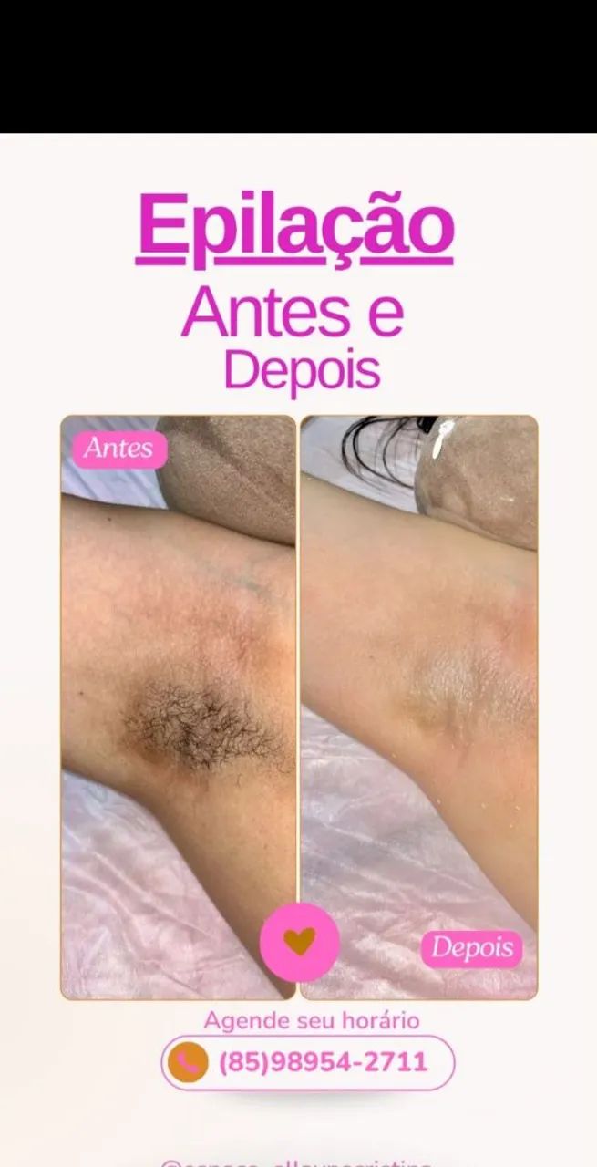 Depilação a cera  - Foto 2