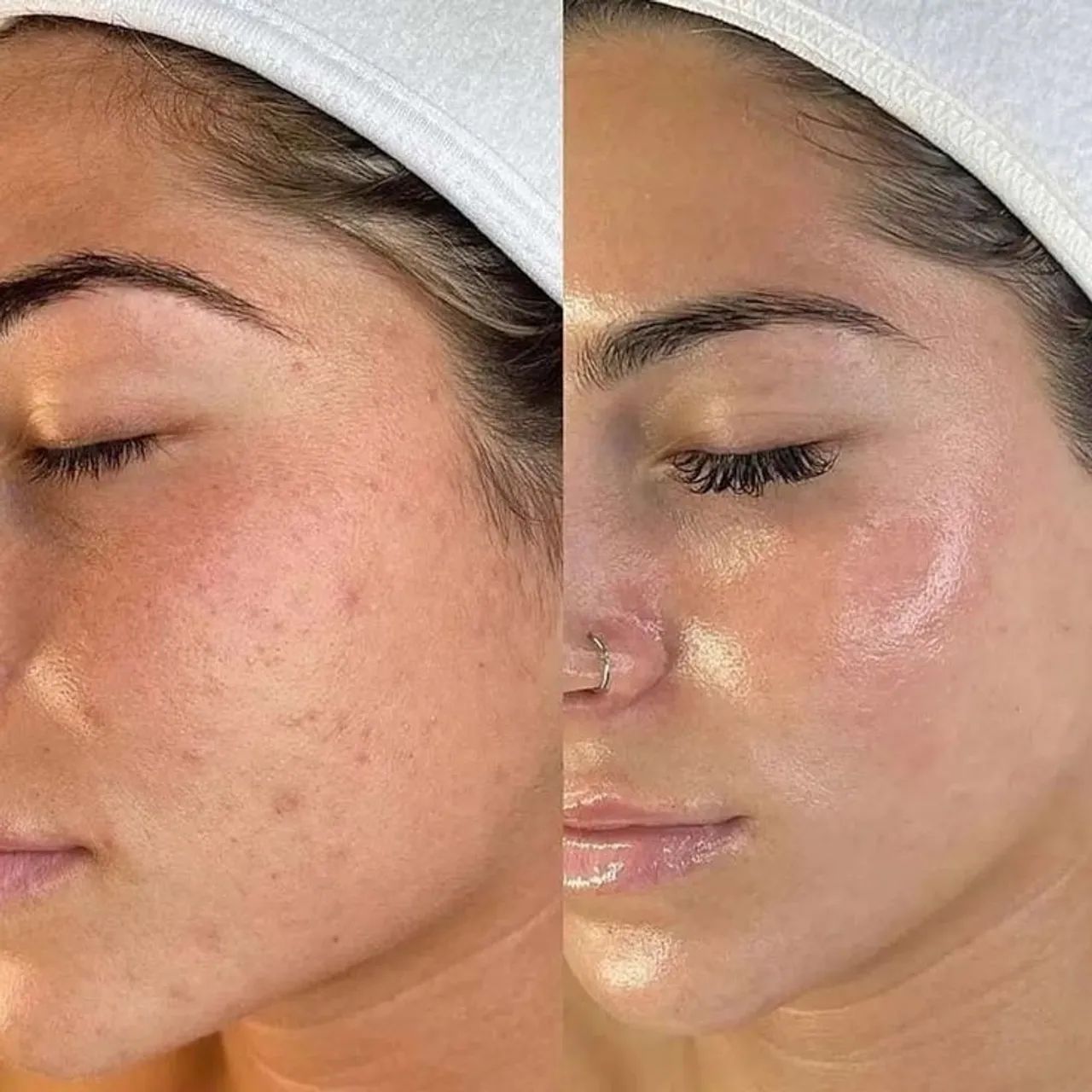 Rejuvenescimento facial  - Foto 3