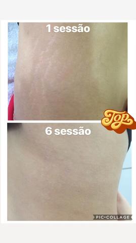 Tratamento para ESTRIAS!!