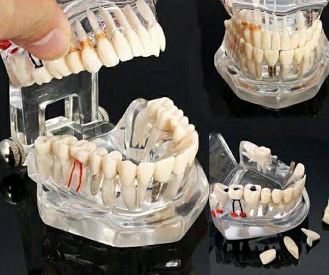 Modelo da arcada dentária - Odontologia
