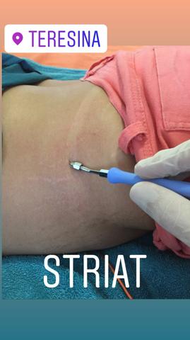 Tratamento para ESTRIAS!! - Foto 2