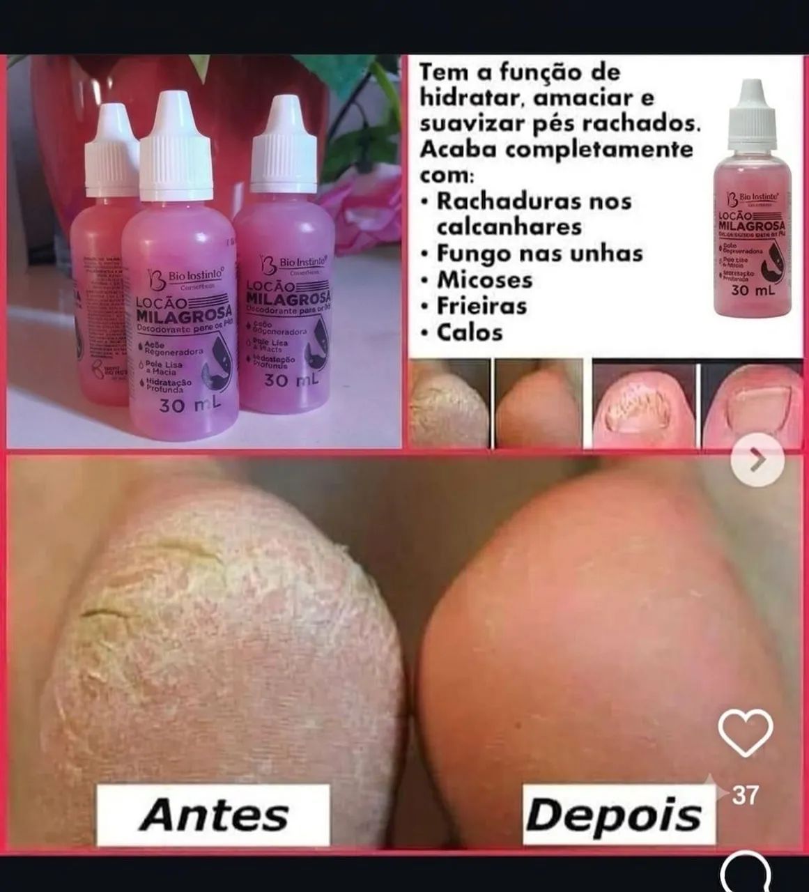 Gotas milagrosa, pés rachados e secos