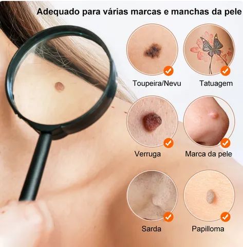 Caneta laser removedora de sinais - Foto 2