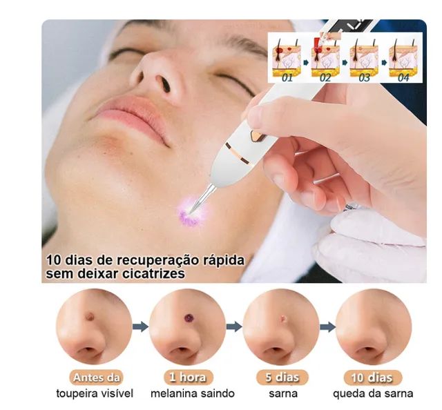 Caneta laser removedora de sinais - Foto 4
