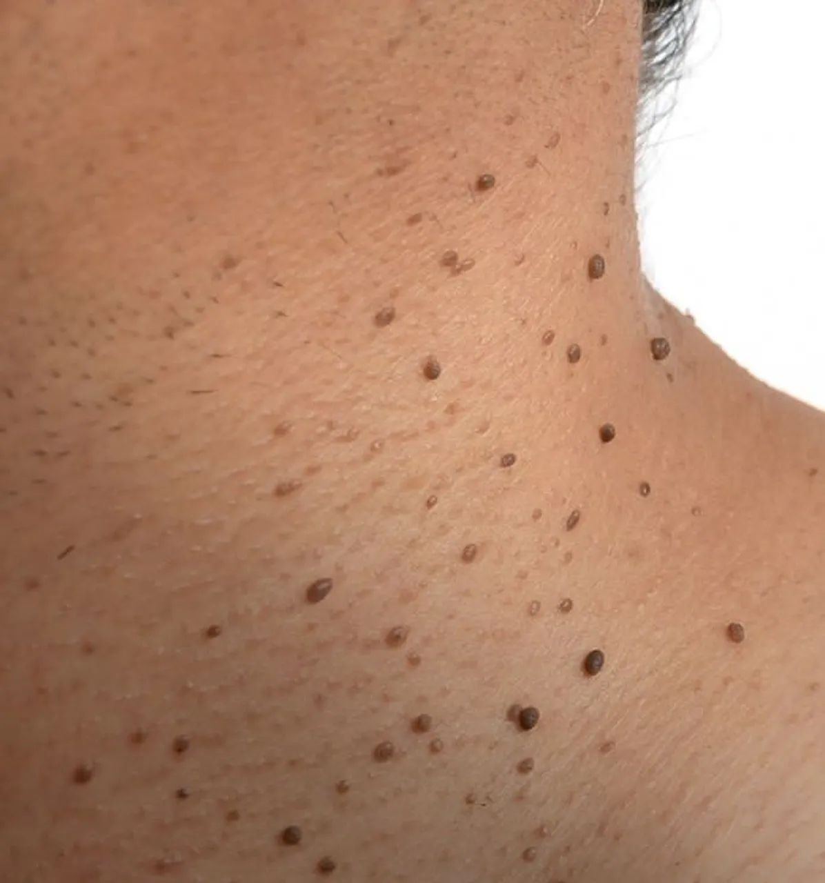 Remoção de verrugas 