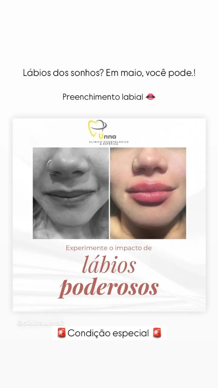 Preenchimento labial