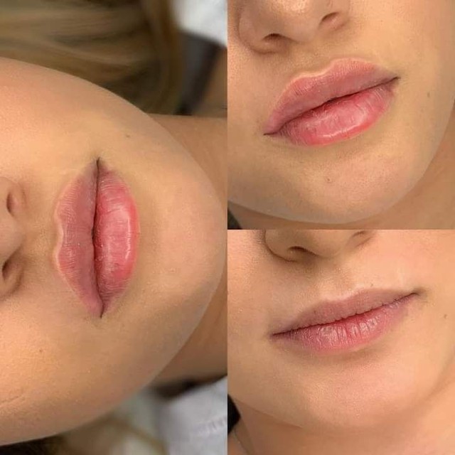 Preenchimento labial - Foto 4