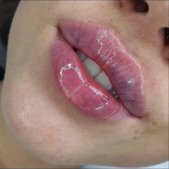 Preenchimento labial - Foto 2