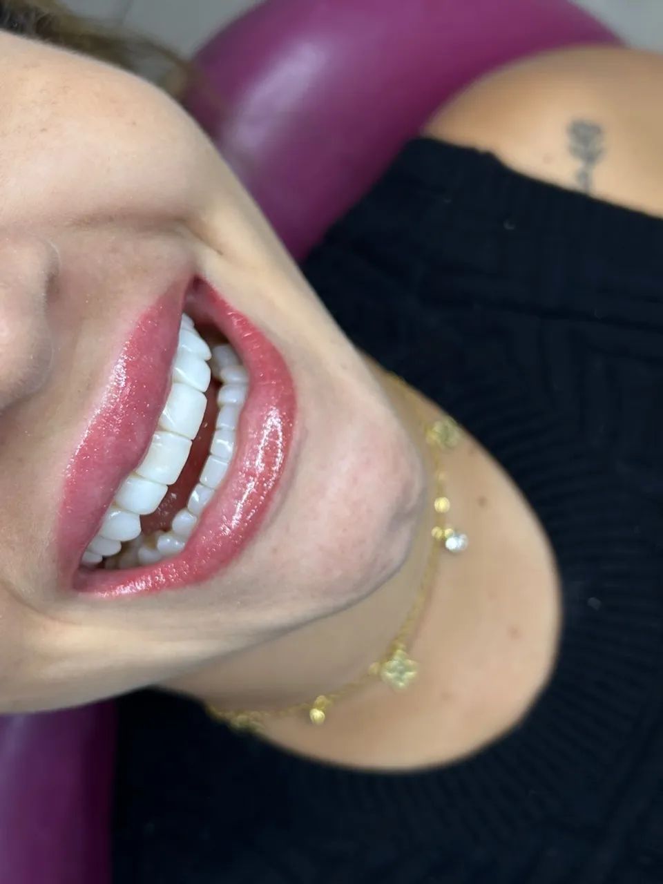 Facetas em Resina Composta