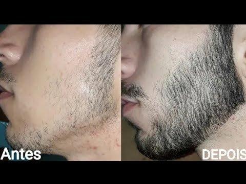 Minoxidil Foligain - Foto 2