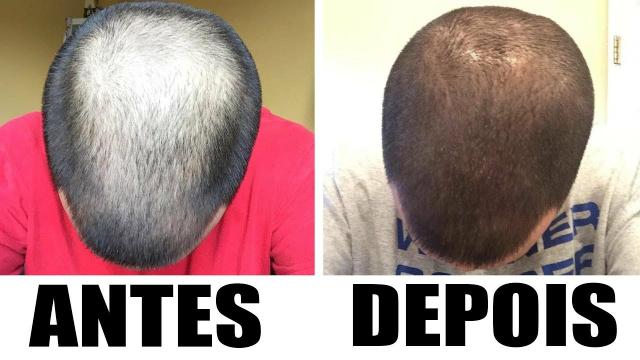 Minoxidil Foligain - Foto 4