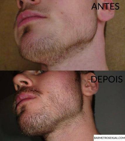 Minoxidil Foligain - Foto 5