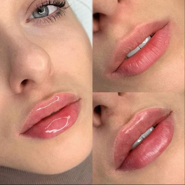 Preenchimento labial - Foto 5