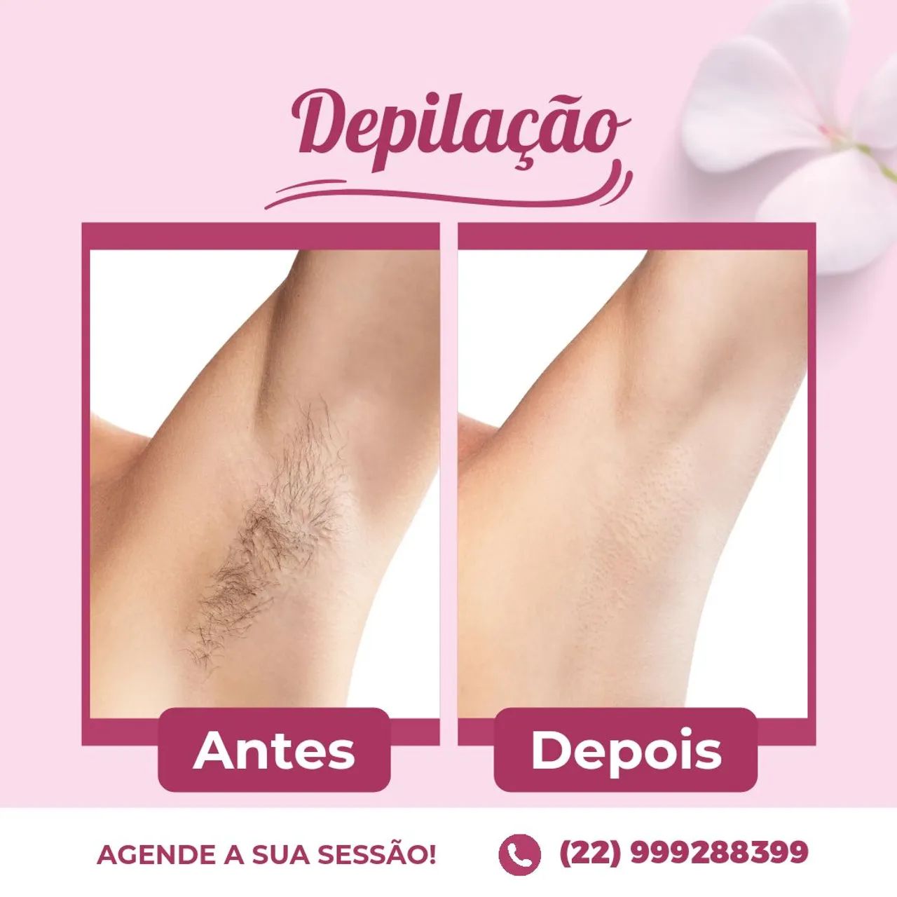 Depilação a domicílio  - Foto 2