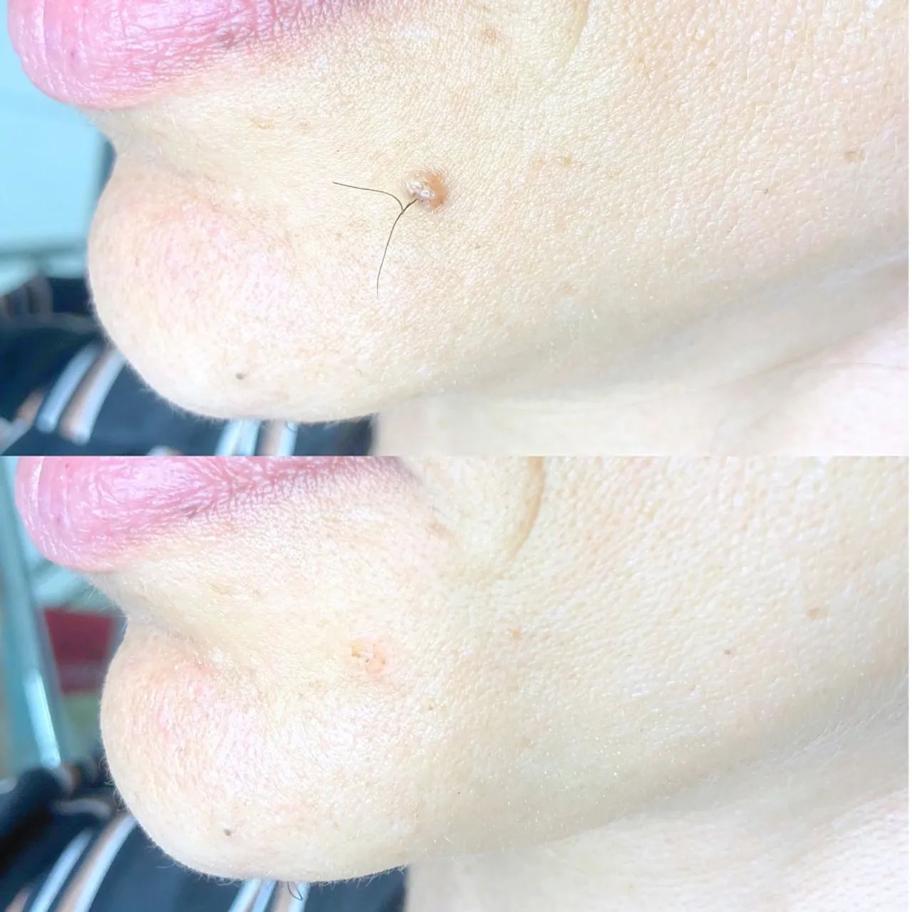 Remoção de Sinais e Verrugas - Foto 4