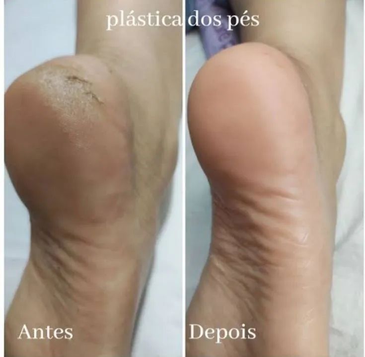 Plástica dos pés /Eldorado contagem 64167812291459123