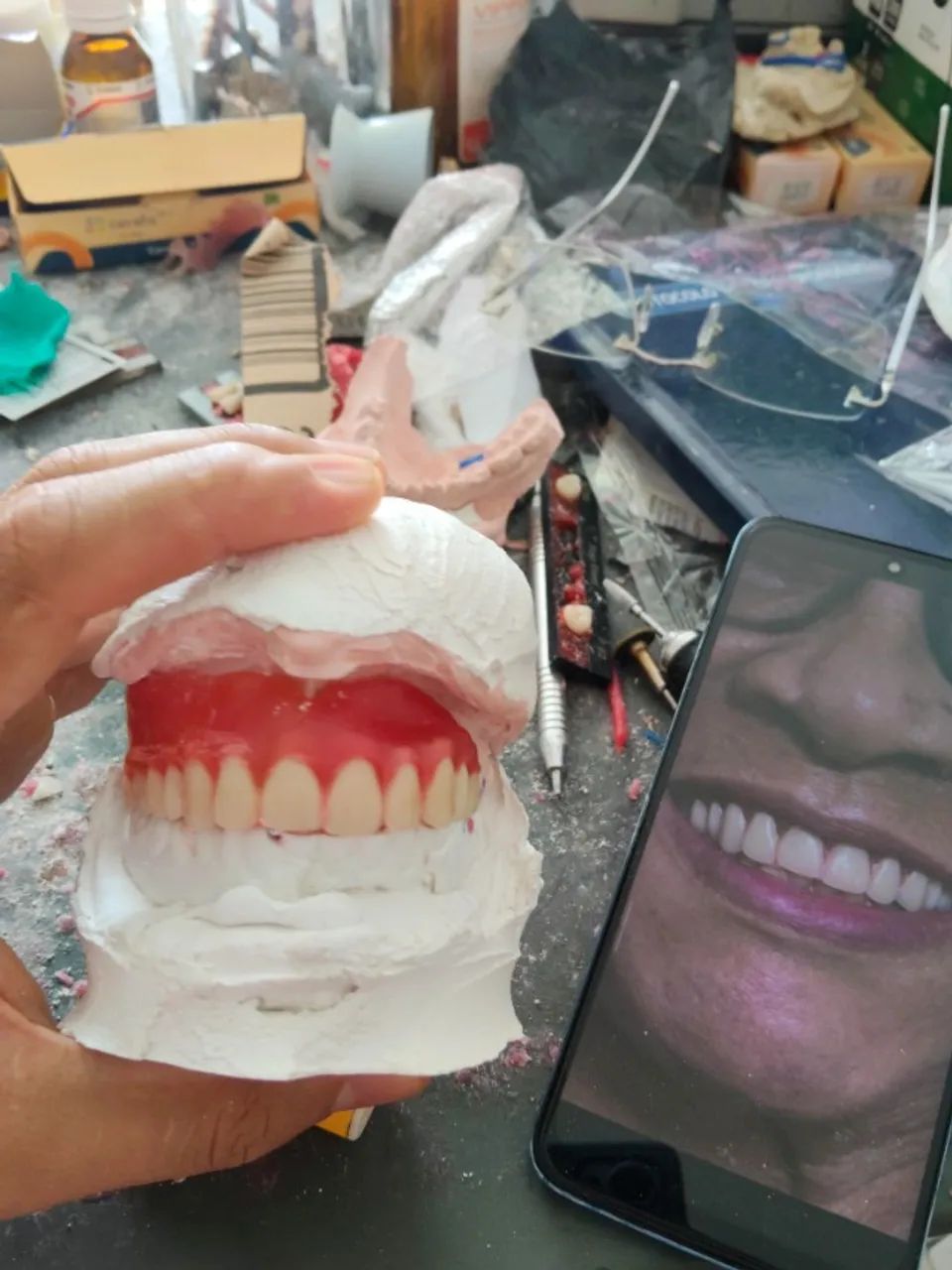 Dentadura + Flex + PLATINA 