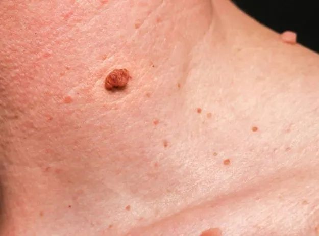 Remoção de verrugas  - Foto 3