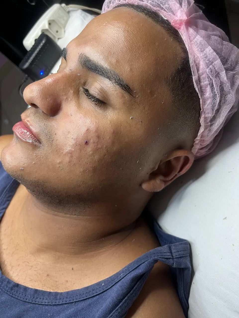 Limpeza de pele a domicílio - Foto 2