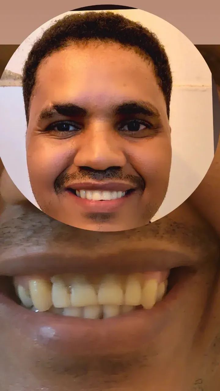 Dentadura + Flex + PLATINA  - Foto 3