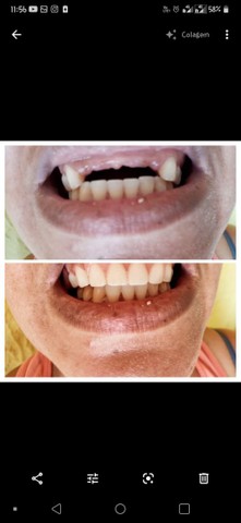 Próteses Dentária - Foto 3