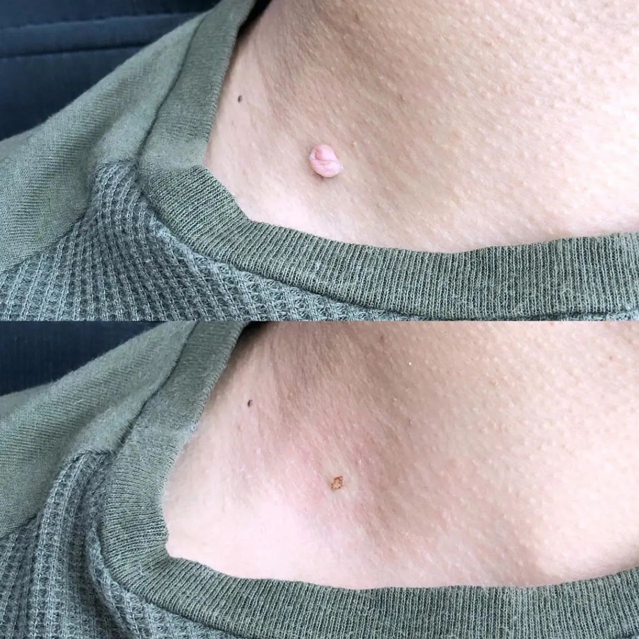 Remoção de Sinais e Verrugas - Foto 2