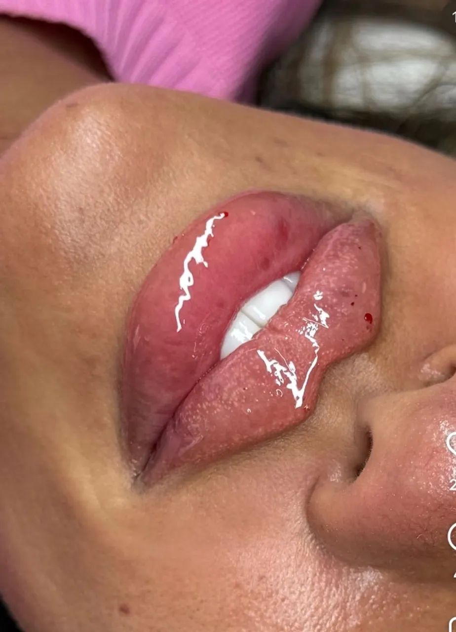 Promoção preenchimento labial - Foto 2