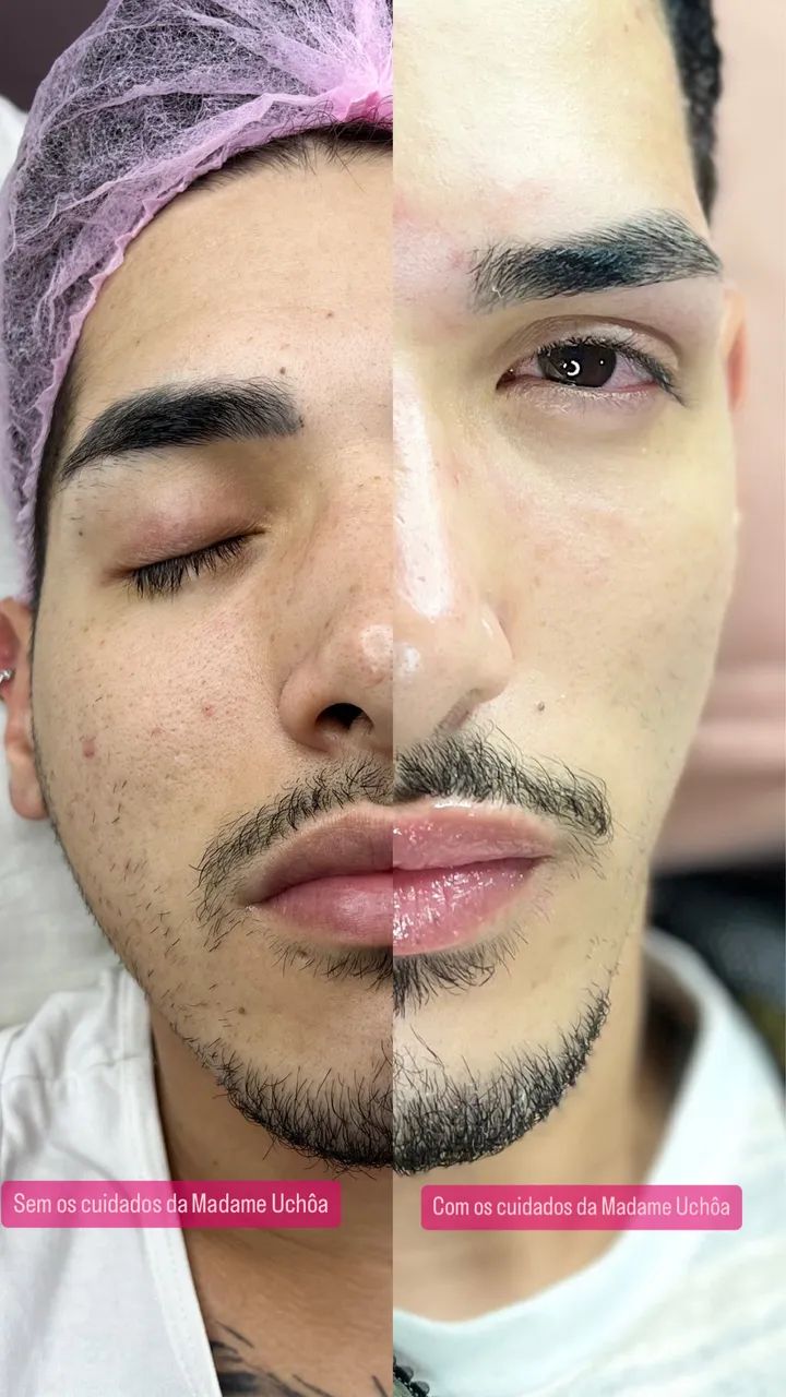 Limpeza de pele a domicílio - Foto 4