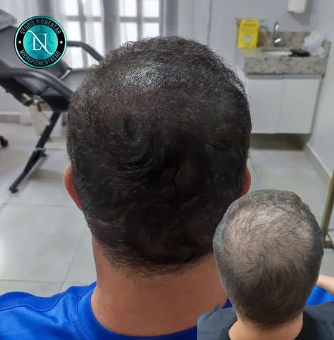 Micropigmentação Capilar  - Foto 3