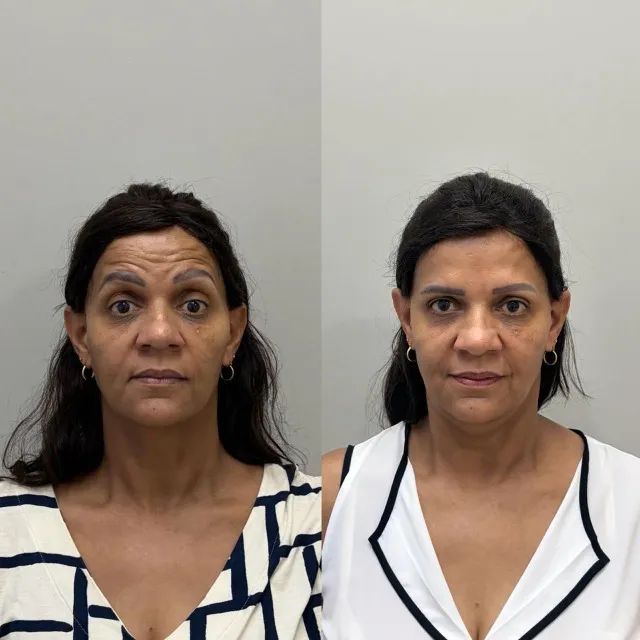 BOTOX: Renove a sua autoestima com botox. - Foto 3