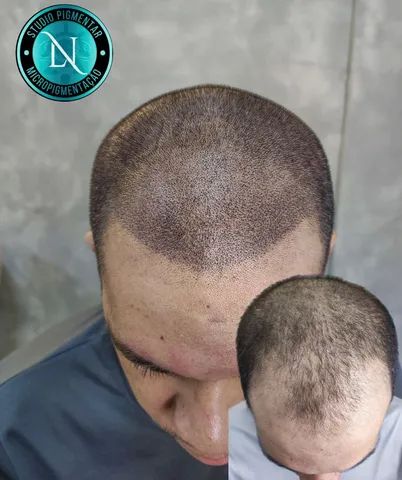 Micropigmentação Capilar 