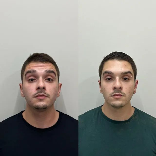 BOTOX: Renove a sua autoestima com botox. - Foto 4