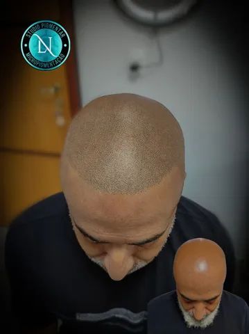 Micropigmentação Capilar  - Foto 4