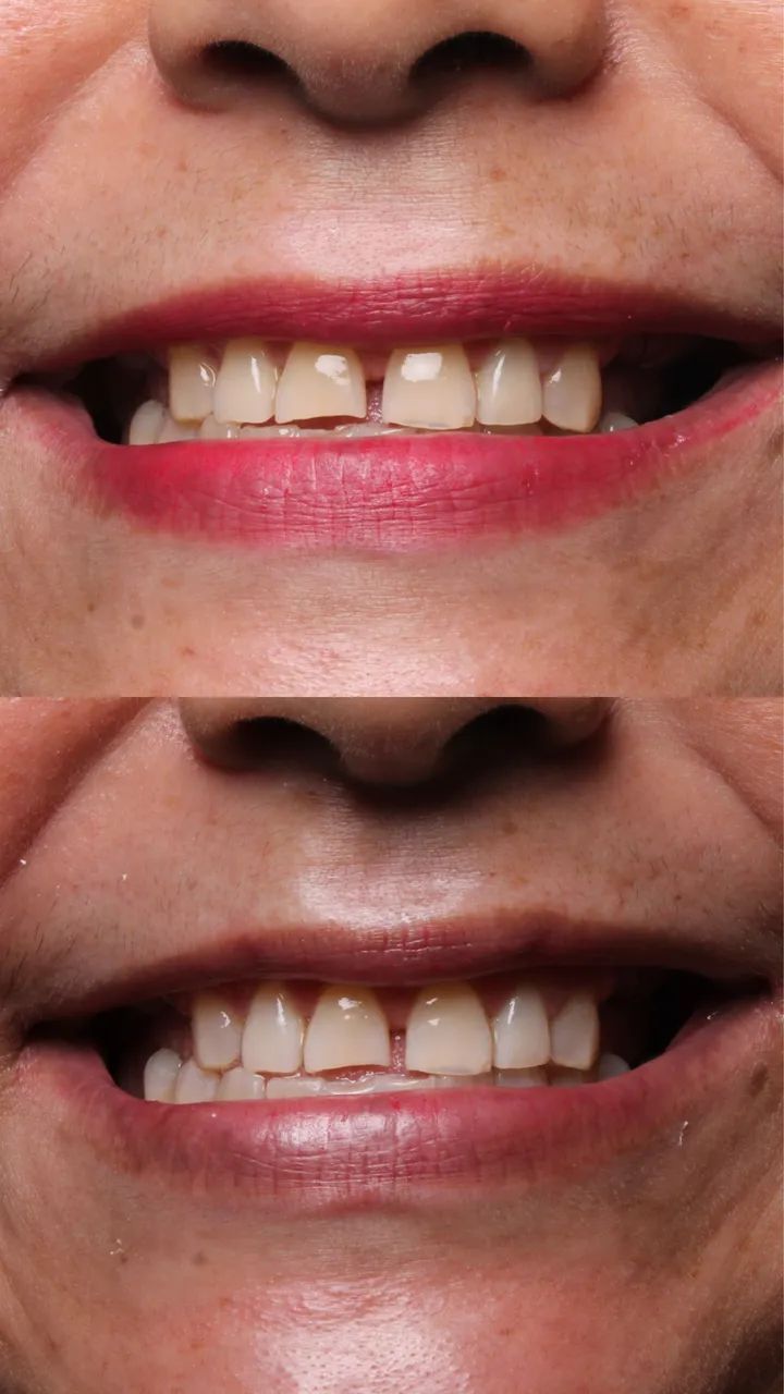 Clareamento dental em consultório  - Foto 4