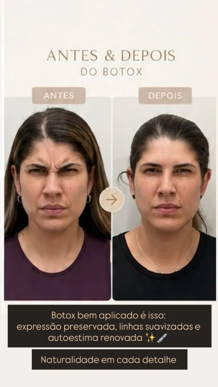 BOTOX: Renove a sua autoestima com botox. - Foto 5
