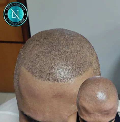 Micropigmentação Capilar  - Foto 2