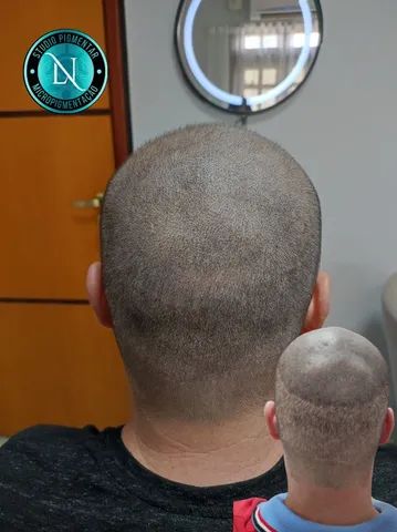 Micropigmentação Capilar  - Foto 5