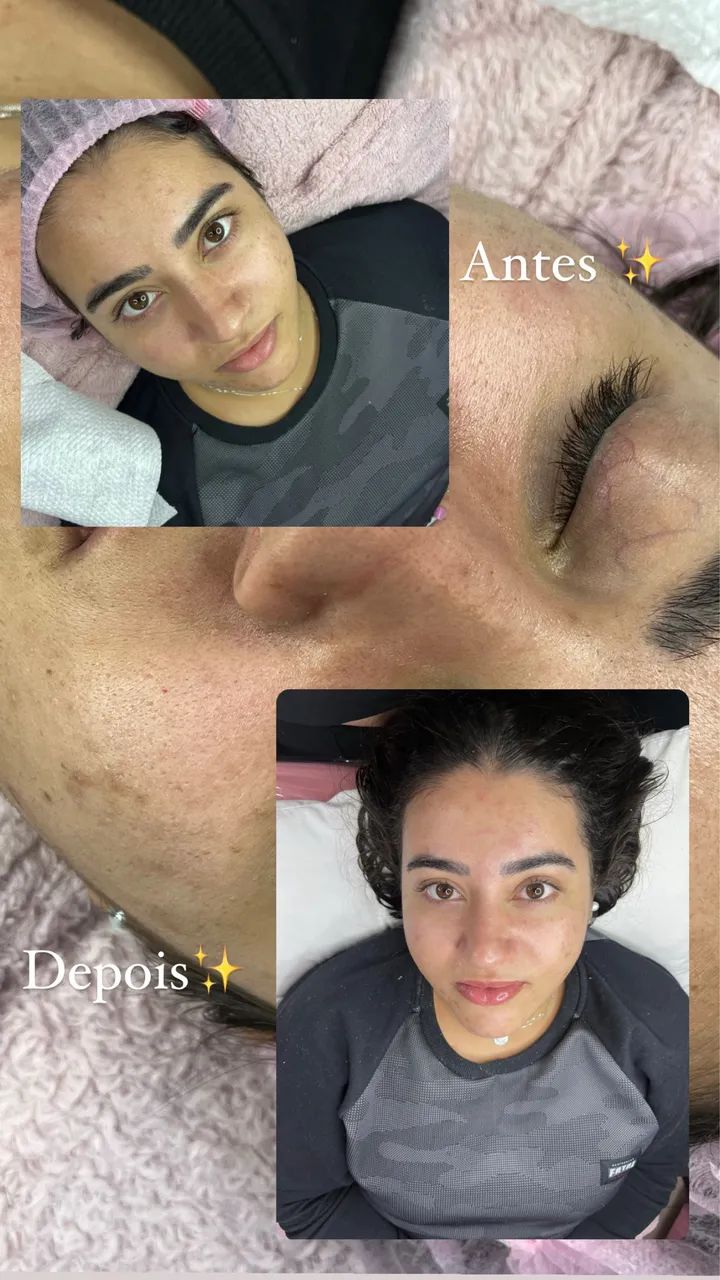 Limpeza de pele a domicílio - Foto 3