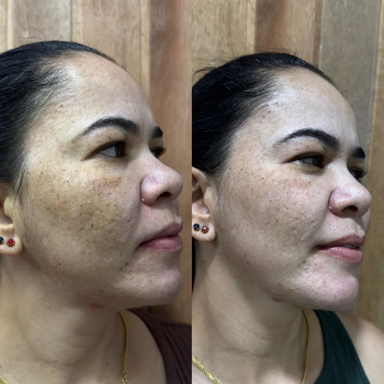 Tratamento para melasma completo e personalizado  - Foto 2